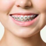 SABİT MEXANİKA İLƏ ORTODONTİK MÜALİCƏ