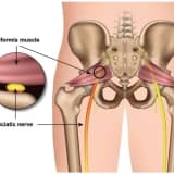 Piriformis Sindromu
