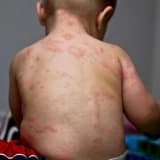 Roseola infantum (Altıncı Xəstəlik)
