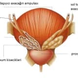 Prostat vəzinin absesinin yaranma səbəbi