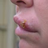 Herpes Simplex (Sadə Herpes)