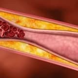 Yüksək xolesterol haqqında