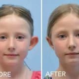 Qulaq Kulunun Estetikası Otoplastika