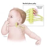 Anadangəlmə qol iflici