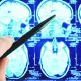 Onurğa Beyni Şişləri (Spinal Tümorlar): Tərif, Səbəbləri və Müalicə Yolları