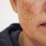 Piqmentasiya xəstəlikləri (Vitiligo, ləkələr)