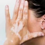 Dermatoskopik Müalicə ilə Vitiligo: Yanaşmalar və Mümkün Təsirləri