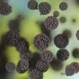 Allergik bronxopulmonal aspergilyoz