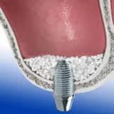 Sinus lifting əməliyyatı və s.