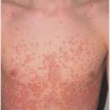 Püstüllər Psoriasis (Psoriasis Pustulosa): Klinik Şiddəti və Müalicə Yolları