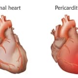 Ürək Pərdəsi İltihabı (Pericarditis): Səbəblər, Simptomlar və Müalicə
