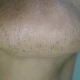 Hirsutizm
