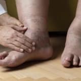 Limfedema (Lympfedema): Səbəblər, Simptomlar və Müalicə Yolları