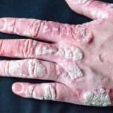 Psoriasis
