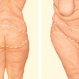 Body Lift: Estetik Cərrahiyyə dünyasının diqqətəlayiq məqamı