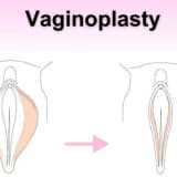 Vaginoplastika