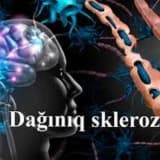 Dağınıq skleroz