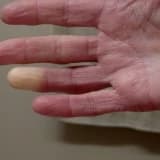 Skleroderma/ilkin sistem sklerozu