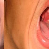 Usaqlarda angina