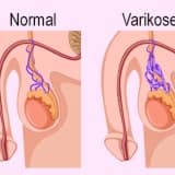 Varikosel