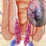 Hemoroid xəstəliyi (Babasil)