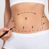 Abdominoplastika əməliyyatı