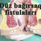 Düz bağırsaq fistulaları