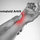Revmatoid artrit