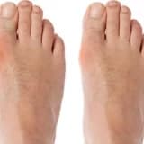 Hallux valgus