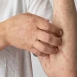 limfoma