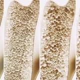 Osteoporoz