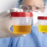 Hematuriya ( sidikdə qan)