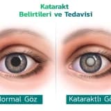 Katarakta: Gözün təbii obyektivində buludluluq