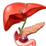 Akalkulyoz Xolesistit