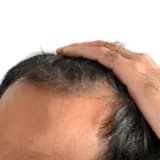 Frontal Lifli Alopesiya: Səbəbləri və Müalicə Yolları