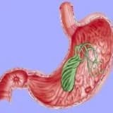 Atrofik Qastrit və İntestinal metaplaziya