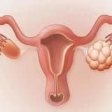 Polikistik yumurtalıq sindromu (PCOS)