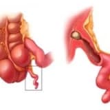 Uşaqlarda kəskin appendisit (APENSİT)