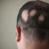 Alopesiyalar (Saç tökülməsi)