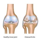 Osteoartrit və omba protezləri