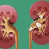 Böyrək daşı nədir?