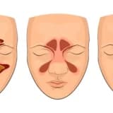 Burun qüsurları, şişlər, yırtıqlar