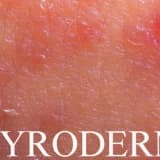 Neyrodermit