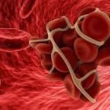 Arterial trombozu