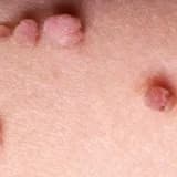 Genital Siğil (hpv) nədir?