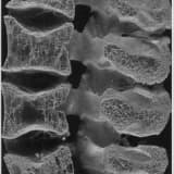 osteoporoz