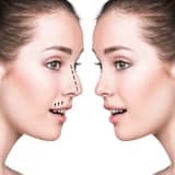 Adenoid-Tonsil Cərrahisi