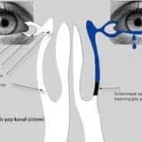 Gözyaşı kanalı tıxanıqlığı