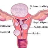 Mioma nədir və necə əmələ gəlir?