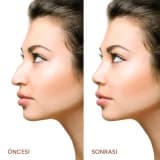 Burun Estetikası (Rinoplastika)